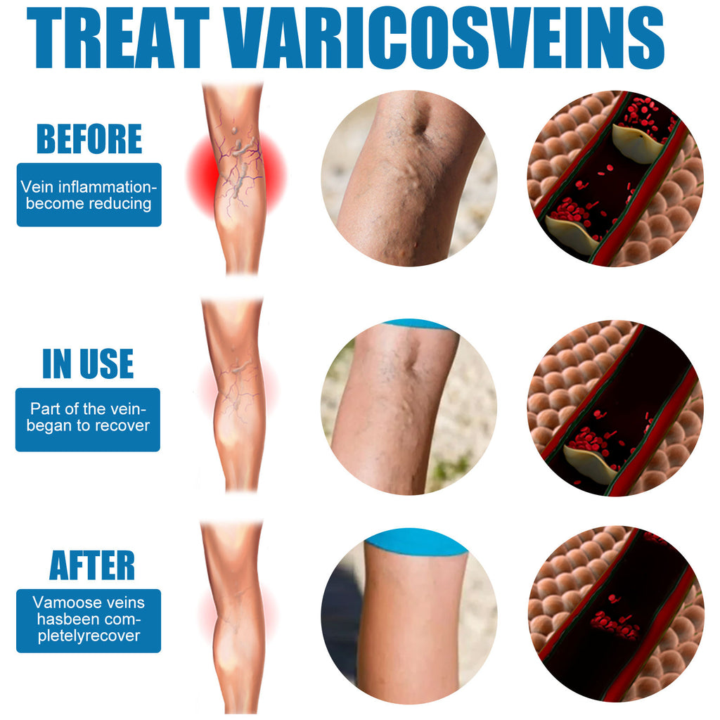 South Moon Varicose Veins Spray